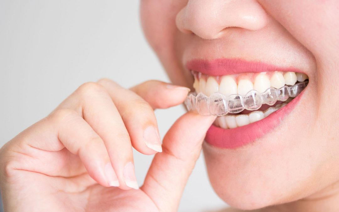 Invisalign Dentist Brampton – 2022